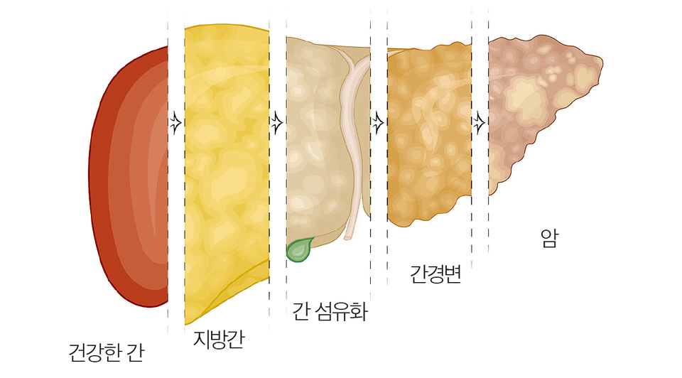 “간암 환자 70~80%가 남자…50대 초반이 가장 많아”