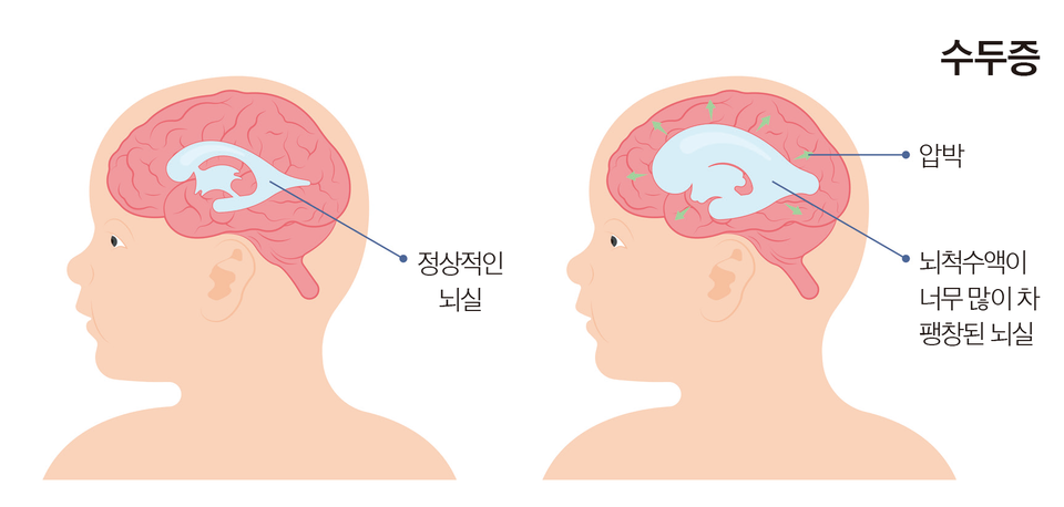 “폐·유방·피부서 온 전이성 뇌종양 비중 높아져”