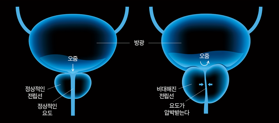 오른쪽 그림은 전립선 비대증으로 오줌길이 좁아진 경우다. 왼쪽의 정상적인 전립선에 비해 전립선 크기가 커지고, 요도가 압박받는 걸 알 수 있다. [이미지=게티이미지]